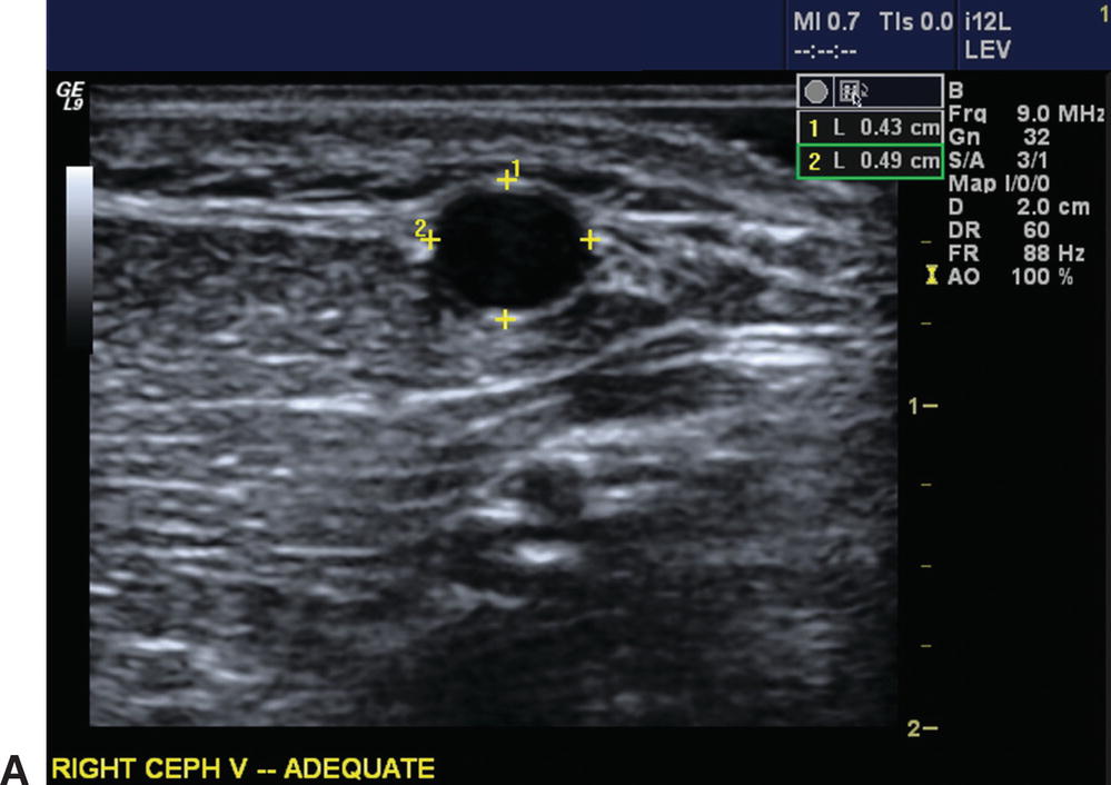 Example Of The Schematics Of A Lower Extremity Vein M