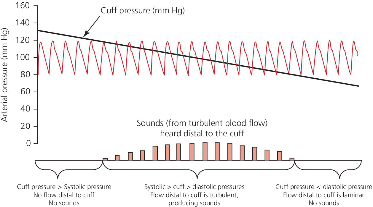 Schematic illustrating the use of transient transition from laminar to turbulent flow in measuring blood pressure, displaying a wave with a negative slope (cuff pressure) and bars (sounds heard distal to the cuff).