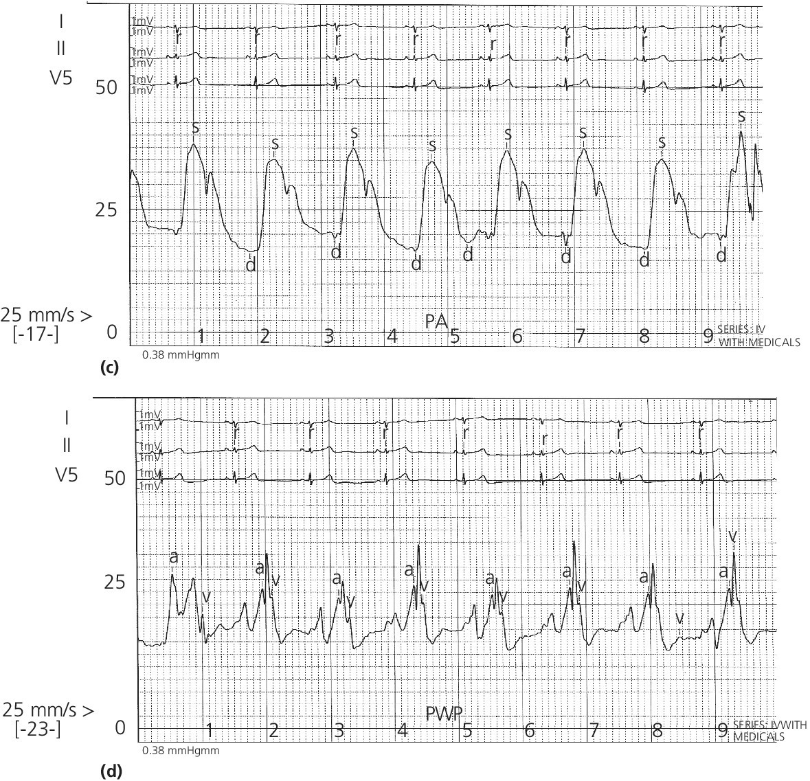 4 ECGs for (from top to bottom) RA, RV, PA, and PWP, displaying pressure tracings encountered during the insertion of a PA catheter.