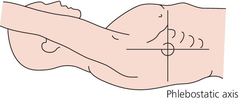 Illustration of a man in supine positon with right arm being raised with intersecting vertical and horizontal lines located a little below the armpit depicting the phlebostatic axis.