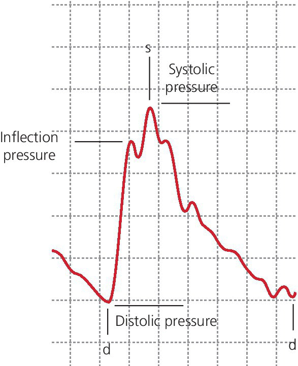 ECG displaying a waveform with lines depicting the systolic, inflection, and diastolic pressure.