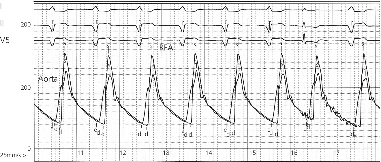 ECG displaying simultaneous aortic and right femoral artery pressures in a 49-year-old male with aortic insufficiency, with higher systolic pressure and rapid increase phase narrower in RFA.