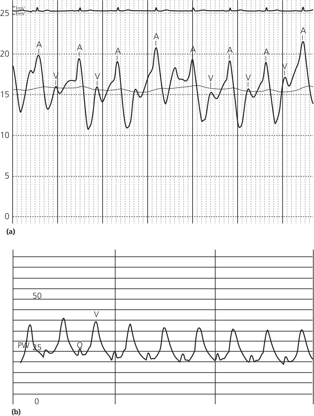 2 ECGs displaying prominent A waves (top) and prominent B waves (bottom).