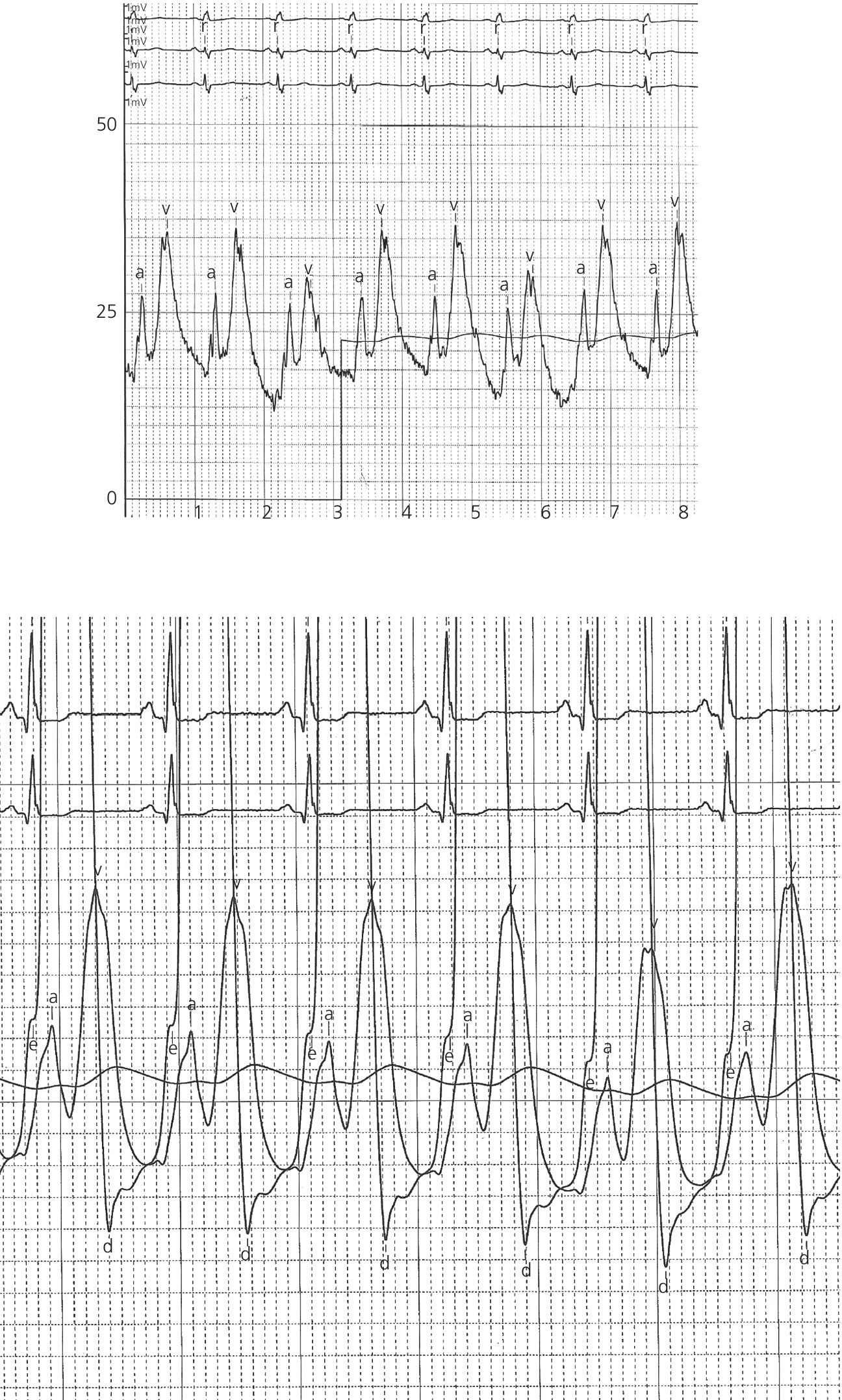 2 ECGs displaying prominent V waves.