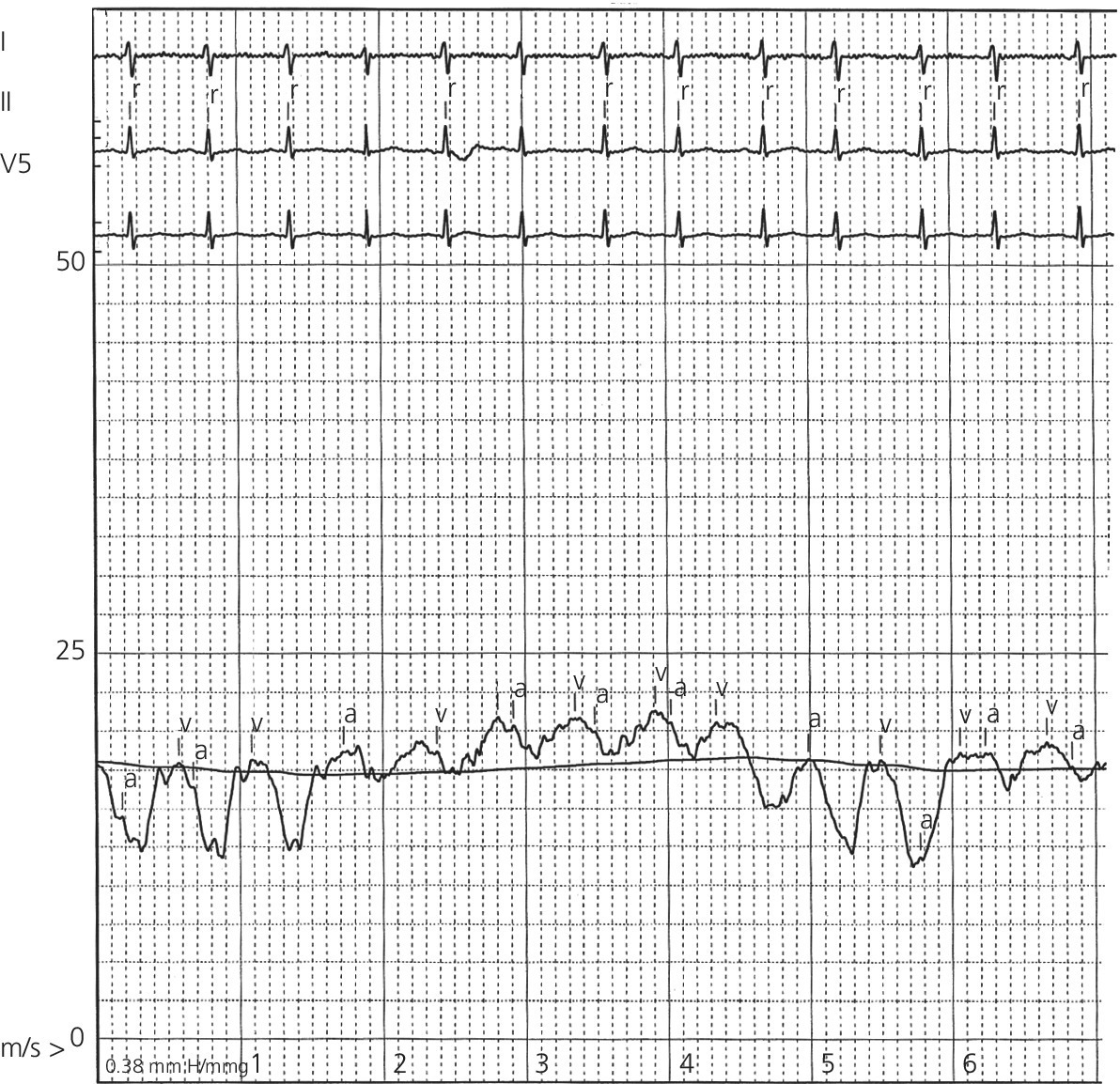 ECG produced by RA tracing in a patient with pericardial tamponade, displaying blunted X and Y descent waves.