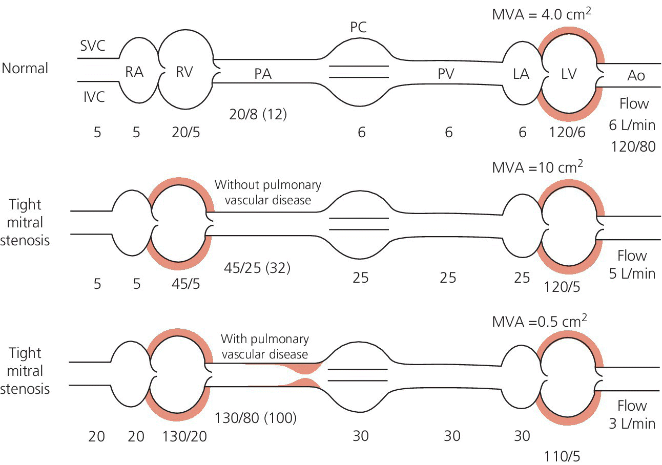 Schematic illustrations of hemodynamic changes of normal (top), tight mitral stenosis without pulmonary vascular disease (middle), and mitral stenosis with pulmonary vascular disease (bottom).