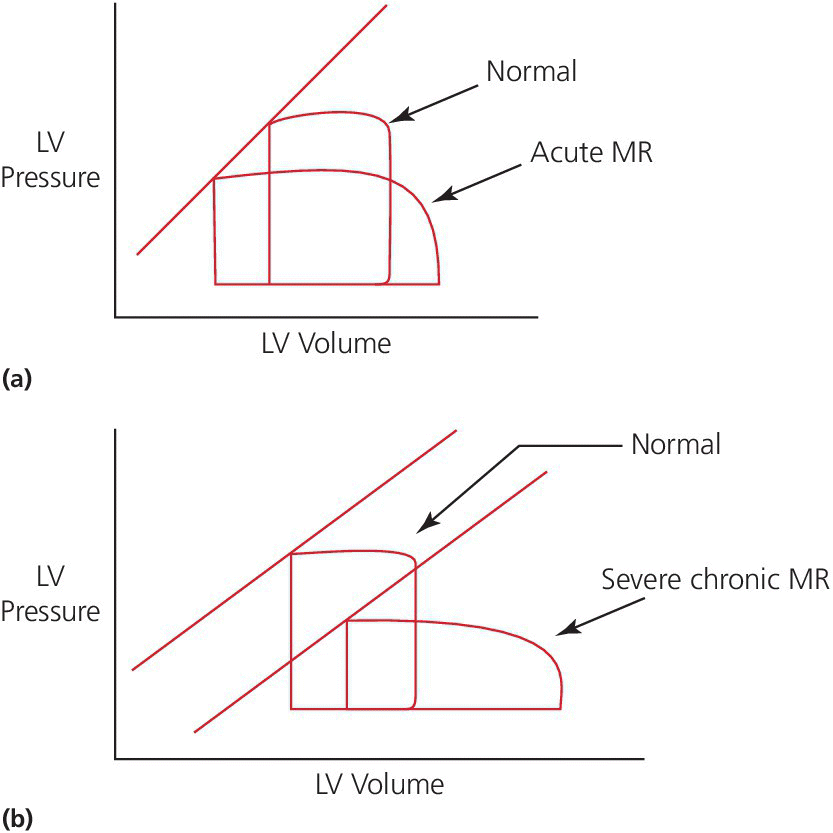 Graphs of pressure–volume loops in acute MR (top) and chronic MR (bottom).
