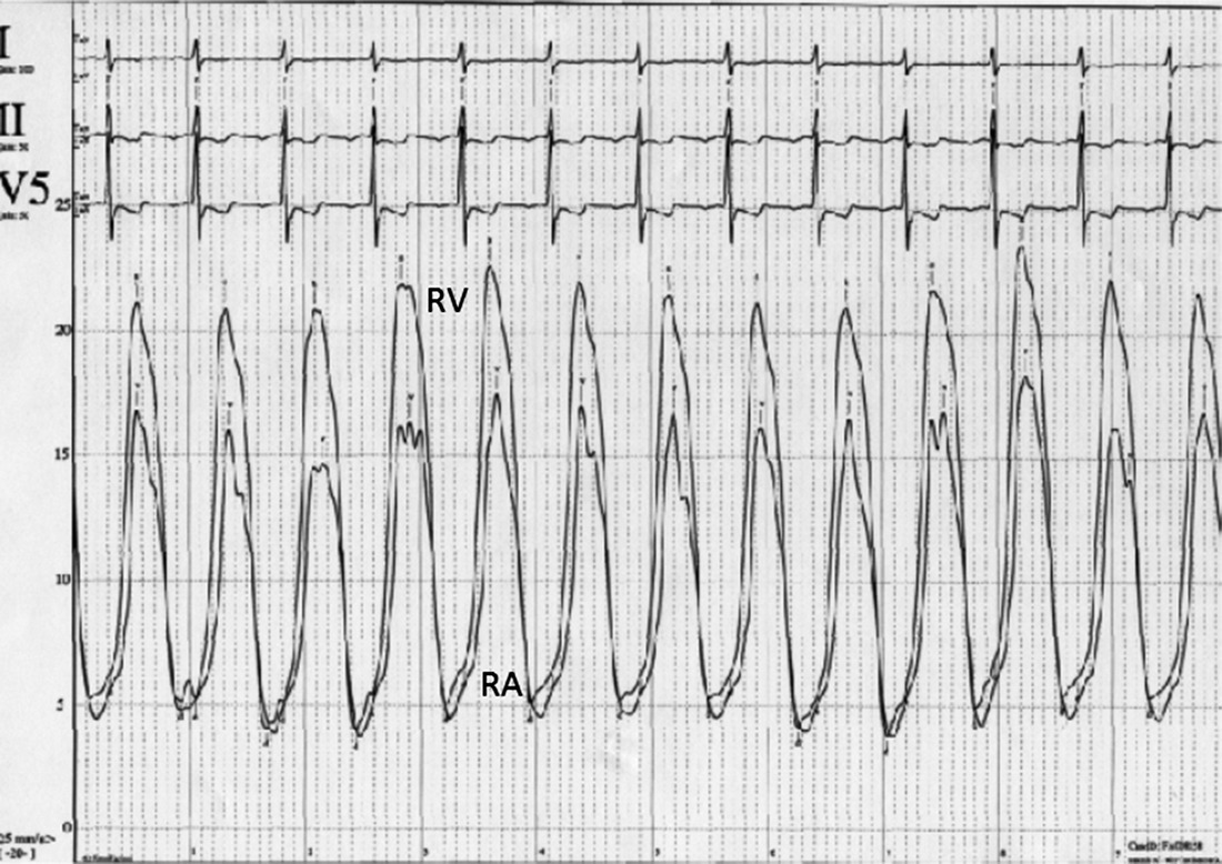 ECG of simultaneous RA and RV pressures from a 67‐year‐old male who had undergone heart transplantation 9 years previously.