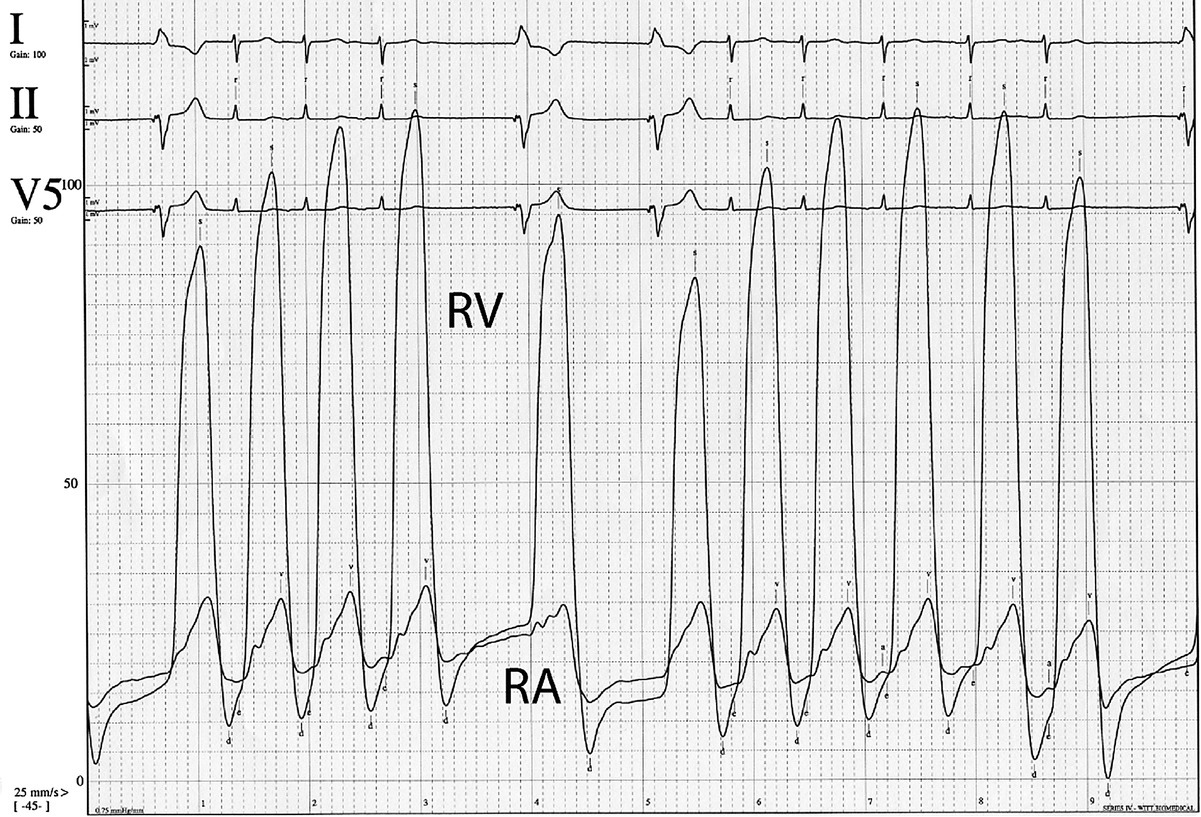 ECG of simultaneous RA and RV pressure in a patient with severe tricuspid regurgitation.