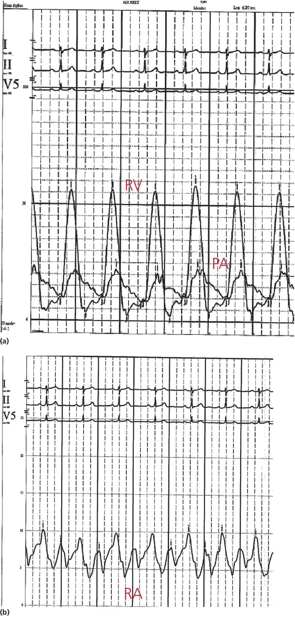 2 ECGs for simultaneous RV and PA tracings (top) and RA tracing (bottom) in a 28‐year‐old female with moderate PS.