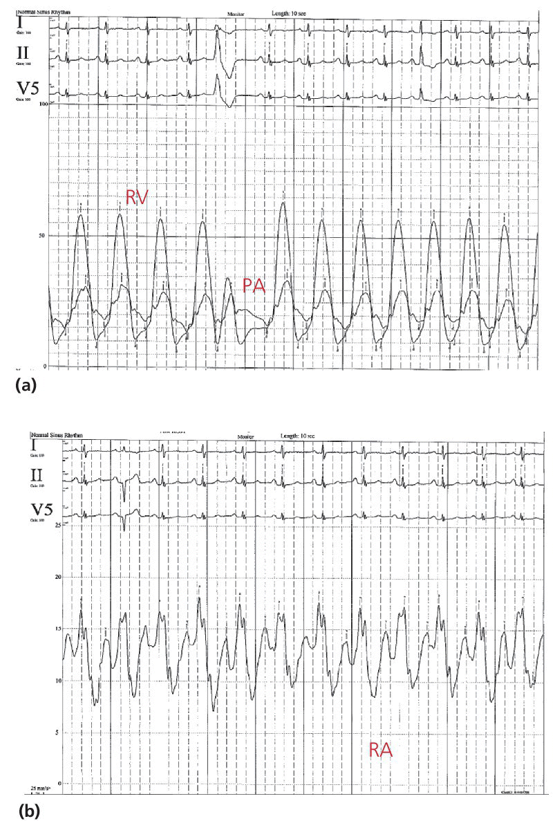 2 ECGs of simultaneous RV and PA tracings (top) and RA tracing (bottom) in a 42‐year‐old female with moderate PS.