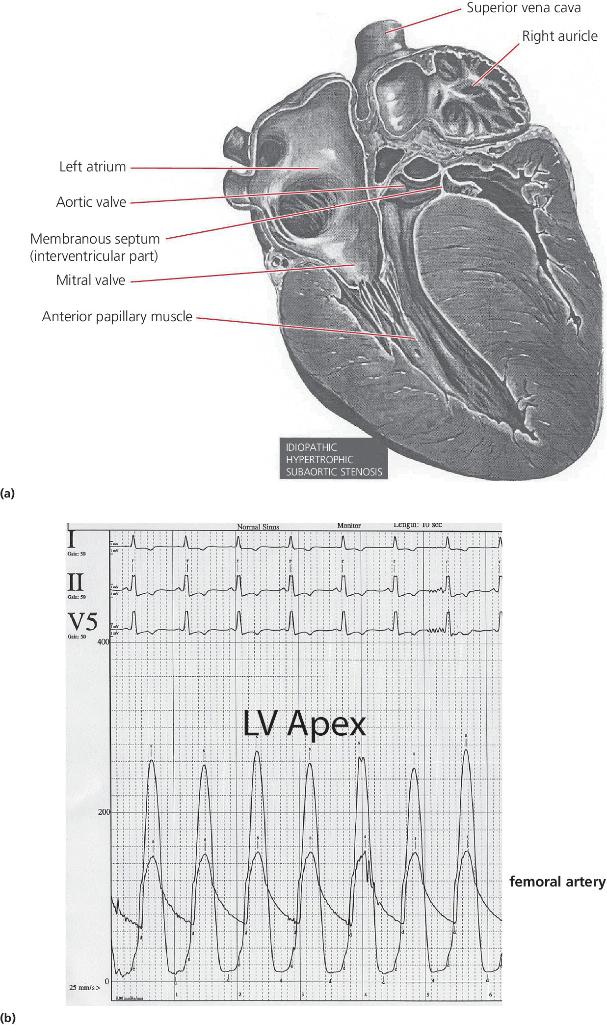 Top: Illustration of the heart with labels superior vena cava, right auricle, left atrium, aortic valve, etc. Bottom: Electrocardiogram displaying waveforms labeled LV Apex and femoral artery.