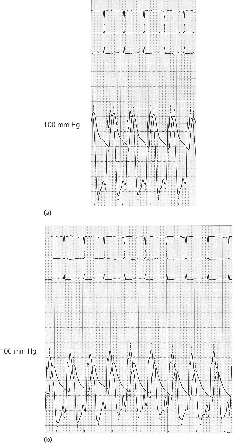 2 Electrocardiograms for LV tracings in a patient with HOCM displaying pressures obtained at baseline with elevated LVEDP (top) and obtained after inhalation of amyl nitrate with increased of LVEDP (bottom).