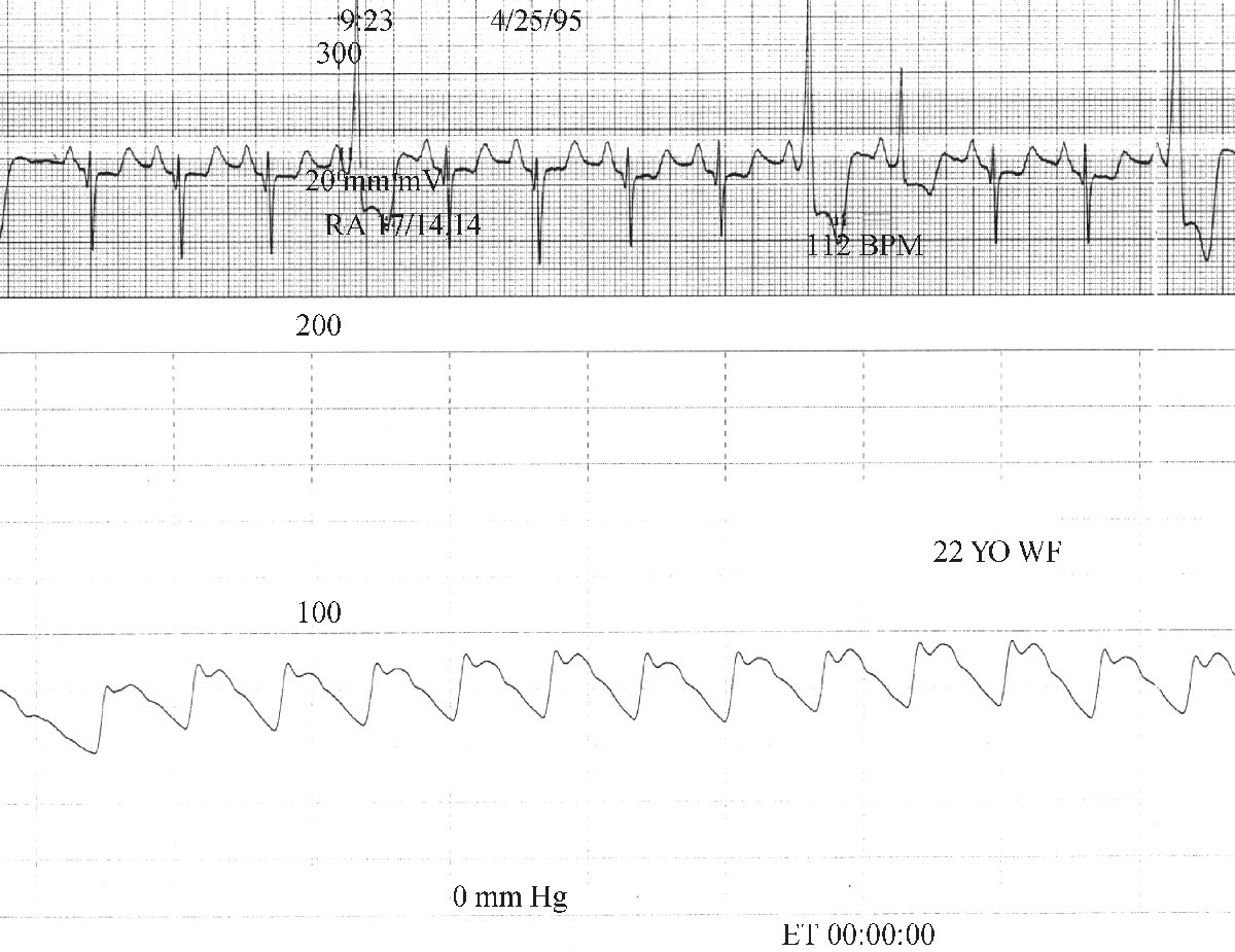 ECG of aortic pressure in a patient with HOCM displaying the “spike and dome” configuration waveform.
