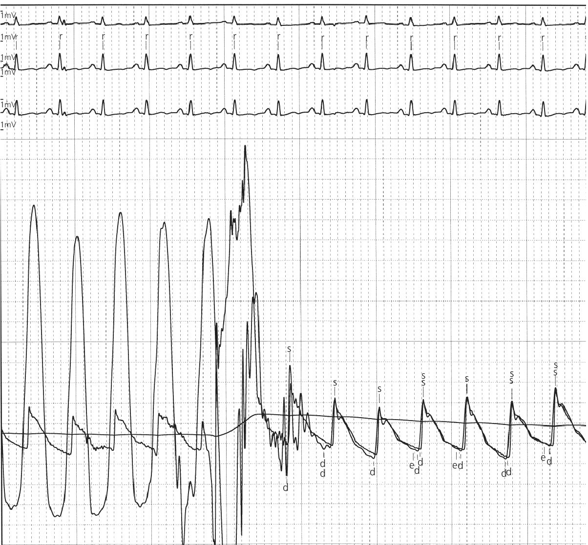 ECG displaying waveform for LV to aortic pullback using a dual lumen end‐hole catheter during amyl nitrate administration.