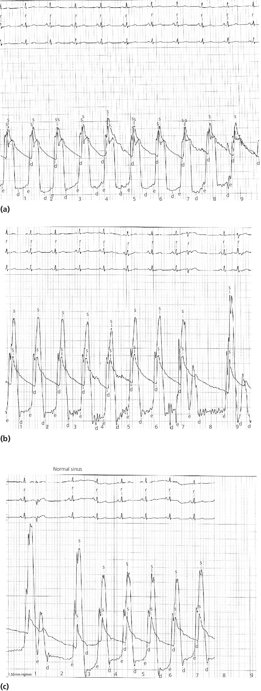 3 ECGs displaying the falling of aortic pressure with gradient (top), aortic pressure continues to fall with increasing gradient (middle), and tracings recorded on 200 mm Hg scale (bottom).