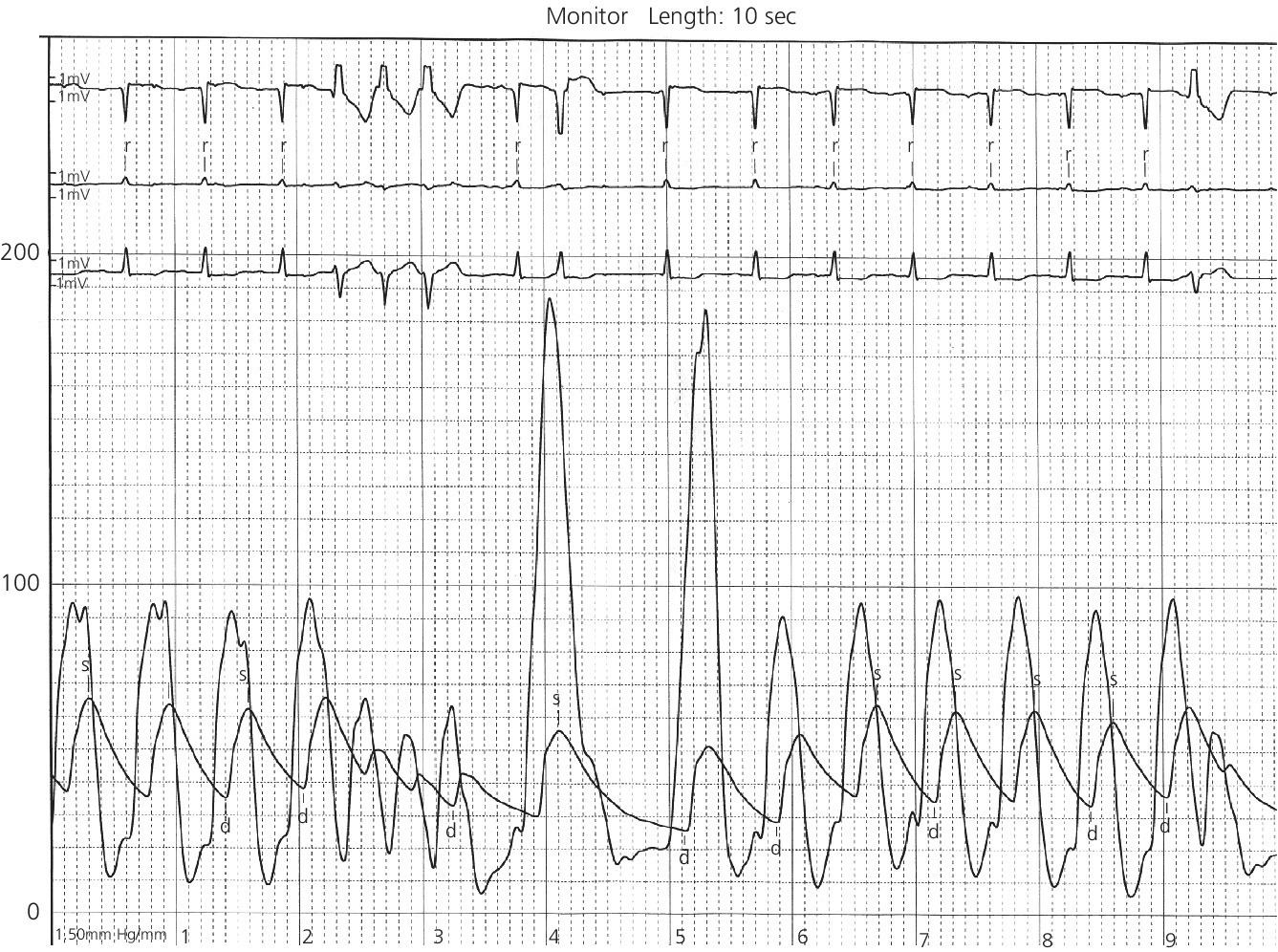 Electrocardiogram demonstrating provocable gradient with PVCs during administration of amyl nitrate.