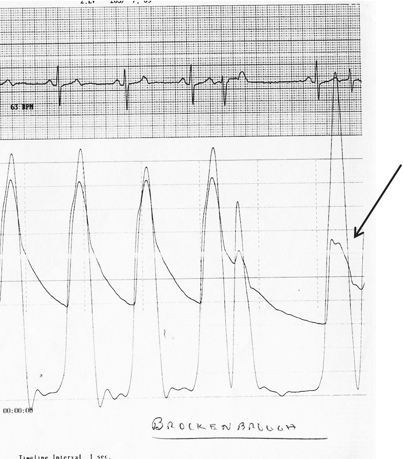 ECG of Brockenbrough–Braunwald–Morrow sign displaying pulse pressure falling in the first normal beat post-PVC depicted by an arrow in HOCM.