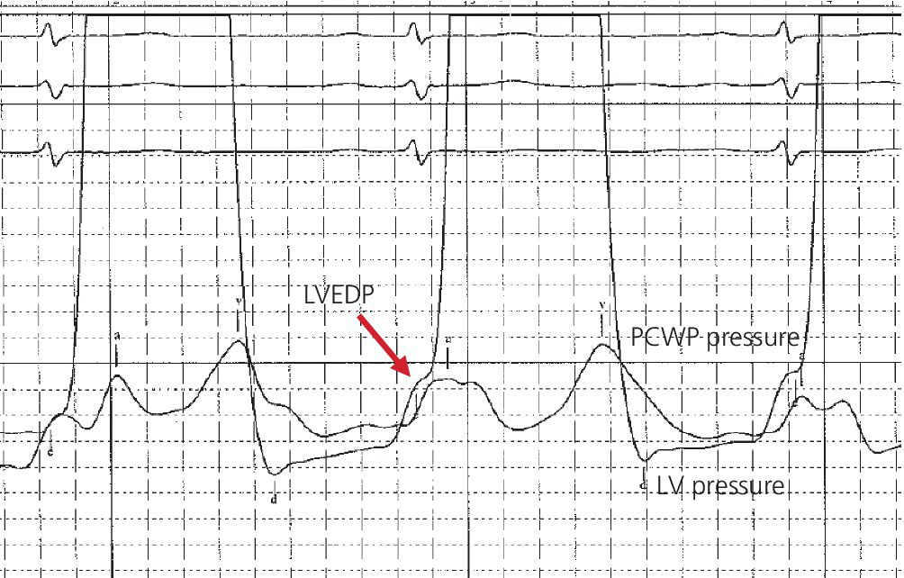Electrocardiogram displaying simultaneous left ventricular and pulmonary capillary wedge pressures.