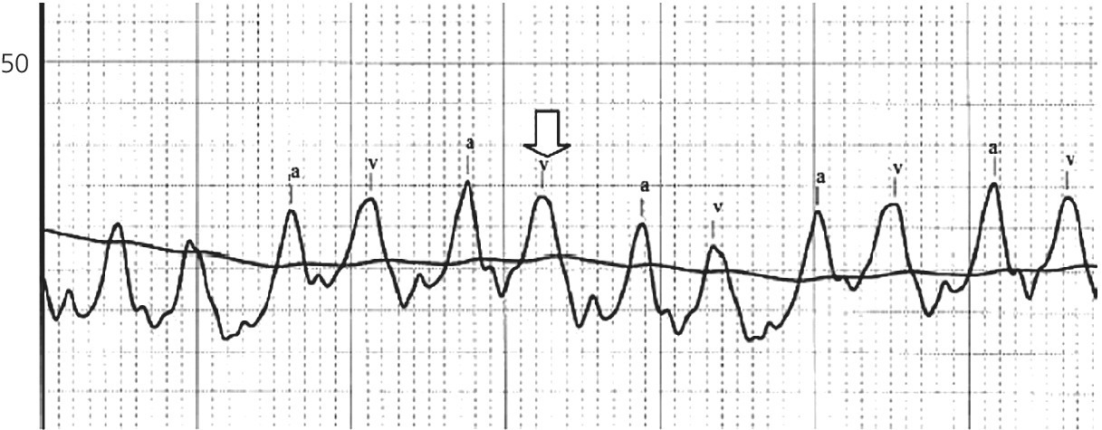 ECG of pulmonary capillary wedge pressure tracing in a patient with dilated cardiomyopathy and severe mitral regurgitation displaying wave plots with peaks labeled a and v.