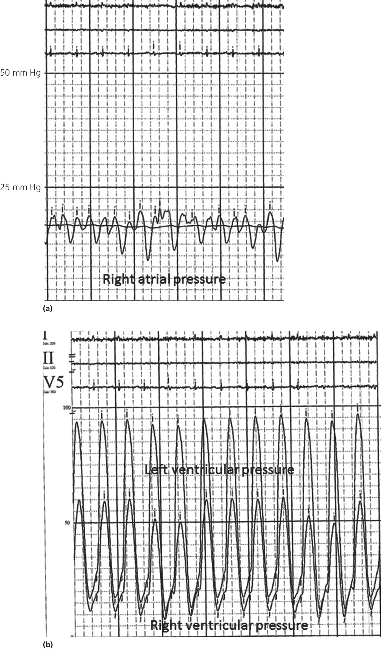 2 ECGs of pressure tracings from a patient with amyloidosis displaying right atrial pressure (top) and left ventricular pressure and right ventricular pressure (bottom).