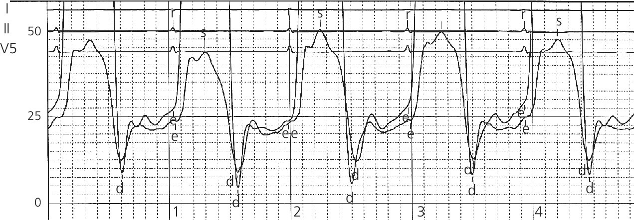 Electrocardiogram of ventricular pressure tracings in constrictive pericarditis displaying “dip and plateau” configuration and the near equalization during mid and late diastole.
