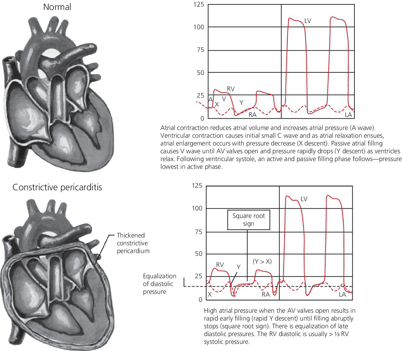 Illustration of normal heart (top) and heart with constrictive pericarditis (bottom) with two graphs displaying solid and dotted waves plots.