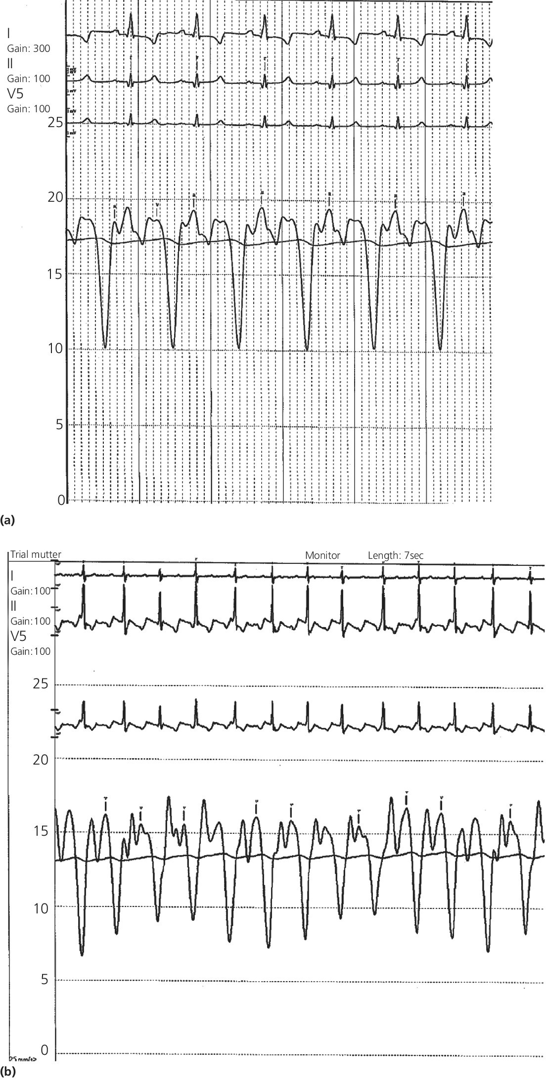 2 ECGs of RA tracings from 2 patients with constrictive pericarditis displaying waves indicating elevated RA pressure, prominent Y descent, and lack of respiratory variation.