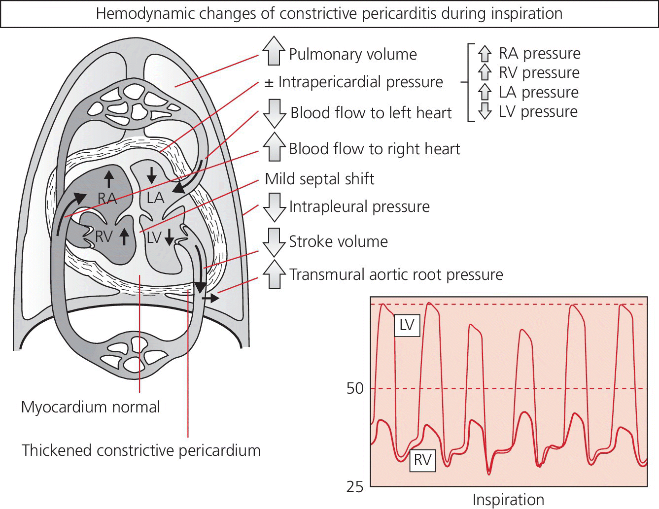 Left: Illustration displaying the effect of respiration on blood flow in mild constrictive pericarditis labeled RA pressure, RV pressure, LA pressure, etc.  Right: Graph displaying waves labeled LV and RV.