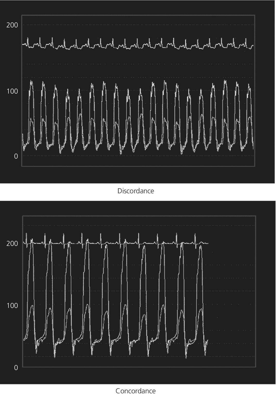 Two electrocardiograms displaying discordance (top) and concordance (bottom).
