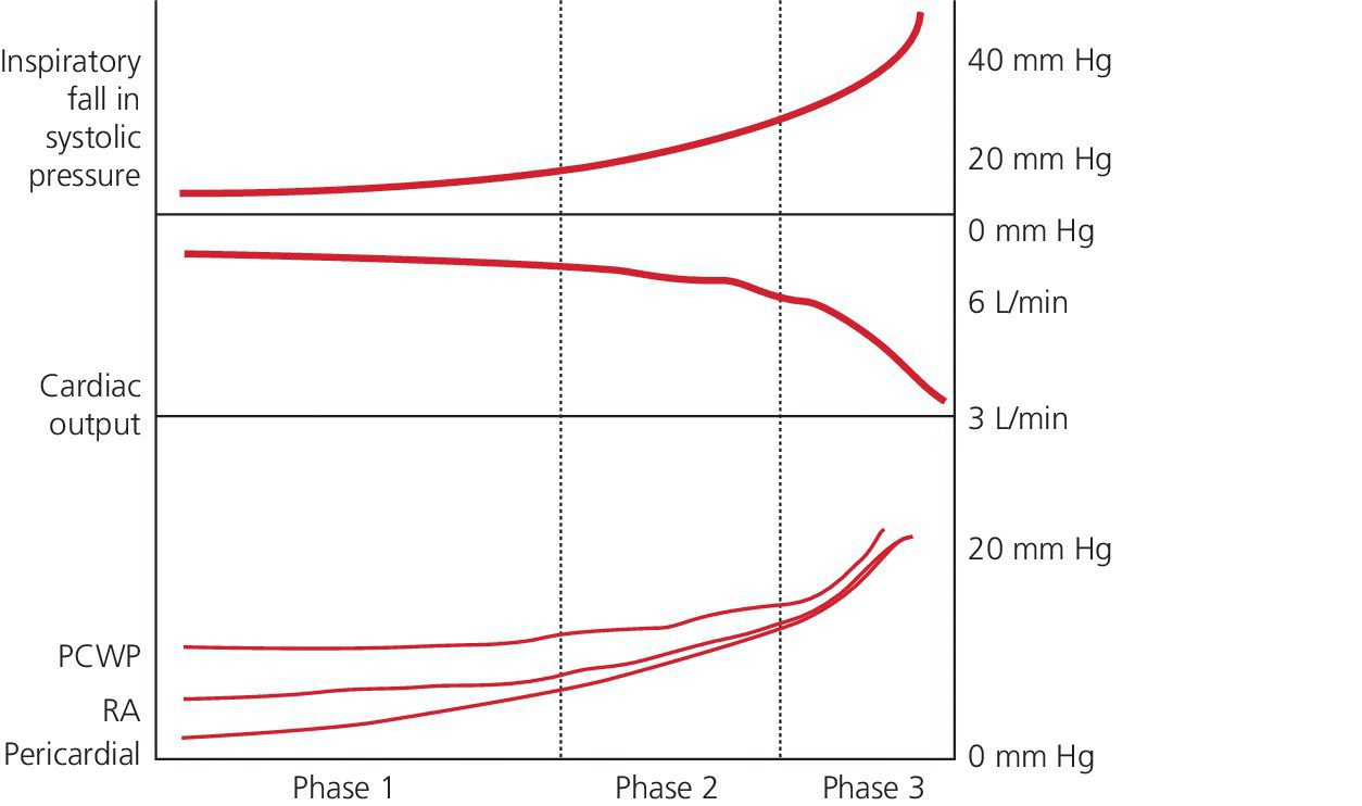Schematic of the phases of cardiac tamponade illustrating five curve plots for inspiratory fall in systolic pressure, cardiac output, PCWP, RA, and pericardial.