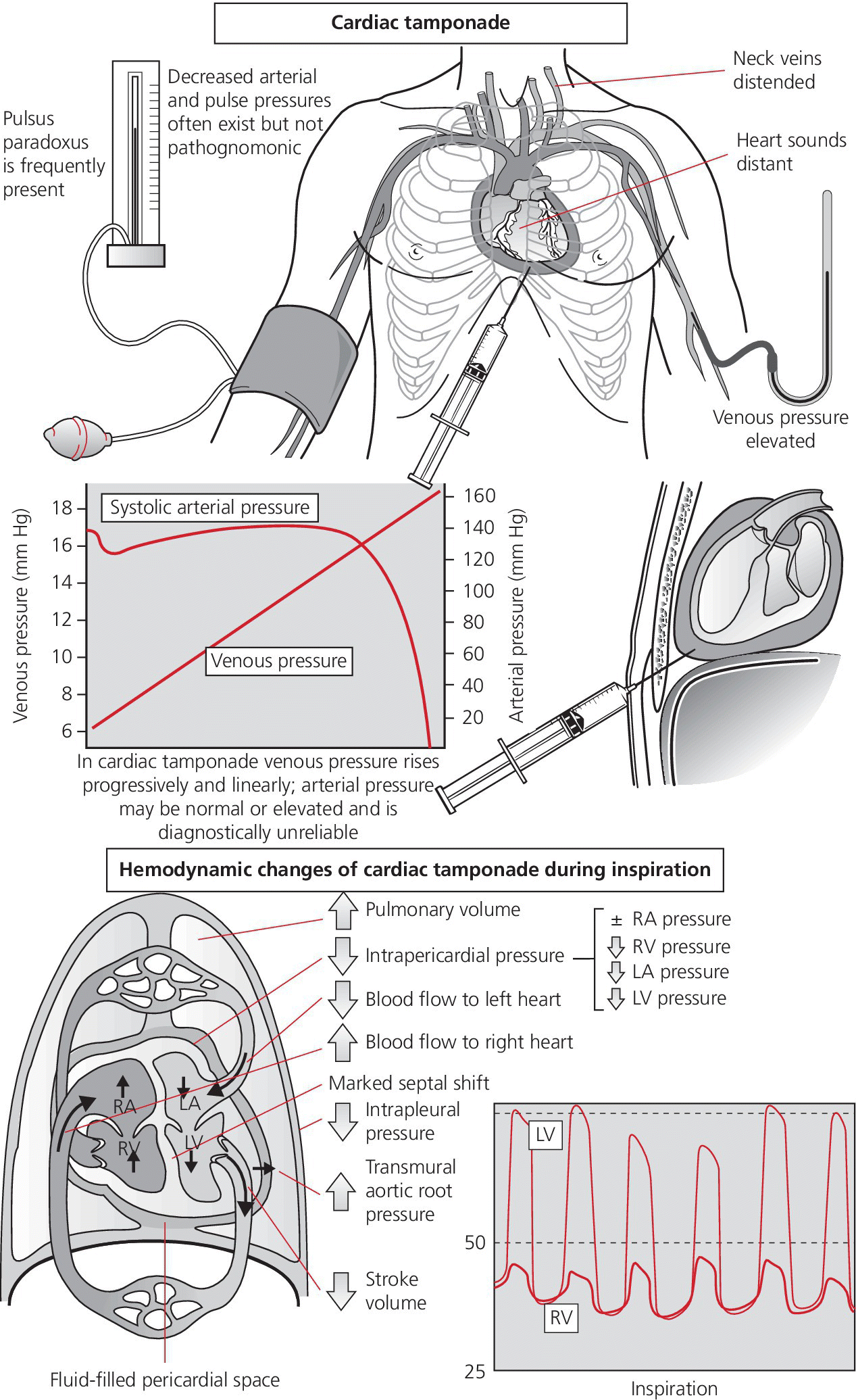 2 Illustrations of cardiac tamponade (top) and hemodynamic changes of cardiac tamponade during inspiration (bottom) with 2 graphs depicting systolic arterial pressure, venous pressure, LV, and RV.