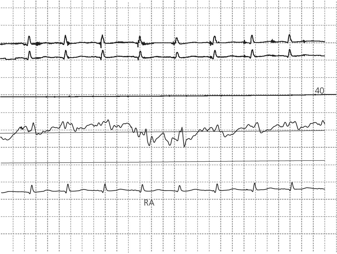 Electrocardiogram depicting RA pressure tracing in a patient with tamponade.