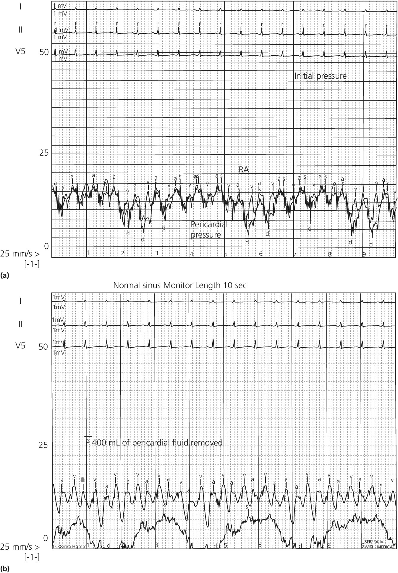 2 Electrocardiograms illustrating simultaneous right atrial and pericardial pressure tracings in a patient with tamponade before (top) and after (bottom) the removal of 400 mL of pericardial fluid.