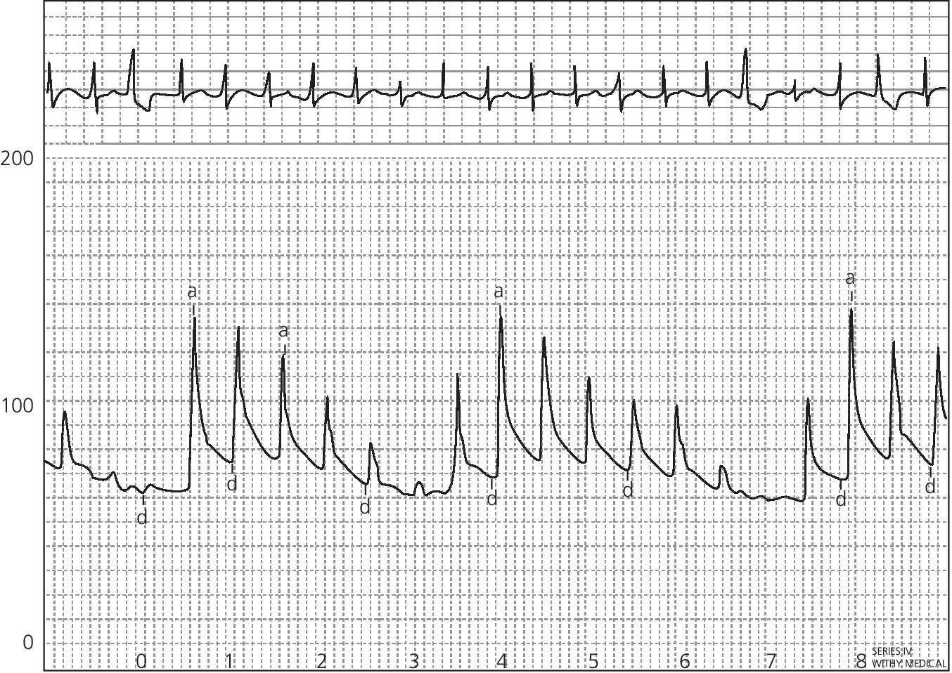 ECG illustrating the aortic pressure tracing in a patient with tamponade displaying pulsus paradoxus.