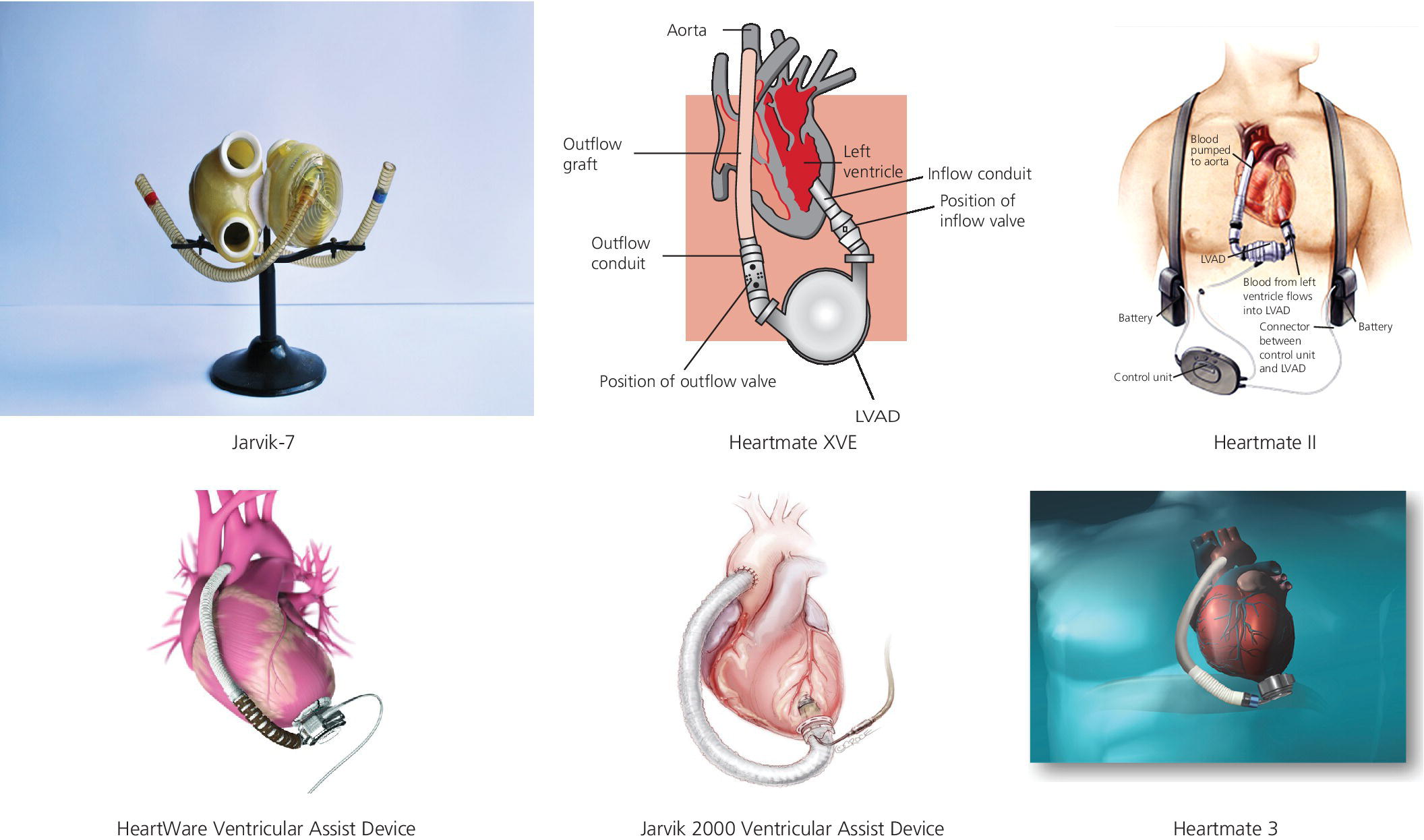 Photo of Jarvik-7 and schematics of Heartmate XVE, Heartmate II, HeartWare ventricular assist device, Jarvik 2000 ventricular assist device, and Heartmate 3 for the different types of mechanical cardiac devices.