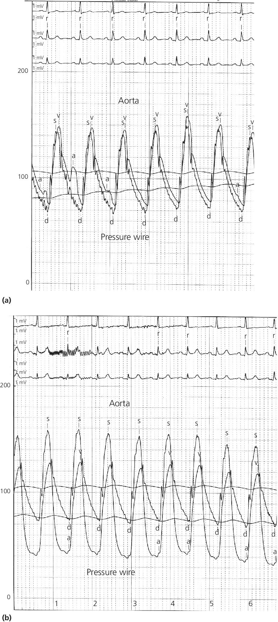 2 ECGs of FFR measurement displaying pressure in aorta and distal LAD (labeled pressure wire) at rest (top) and following intracoronary administration of adenosine (bottom).