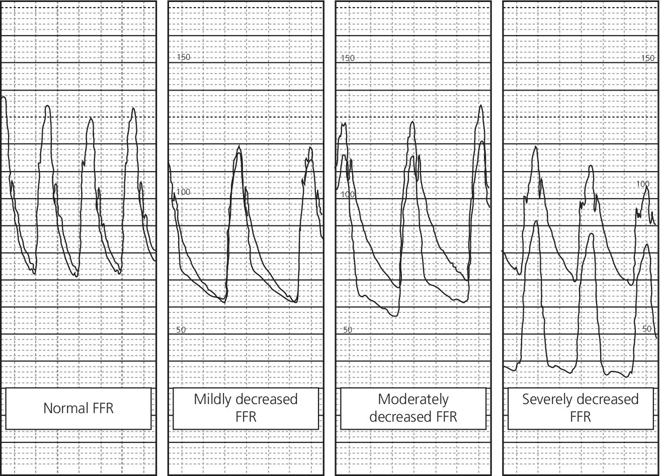 4 ECGs displaying (from left to right) normal FFR and mildly, moderately, and severely decreased FFR from 4 patients with coronary disease.
