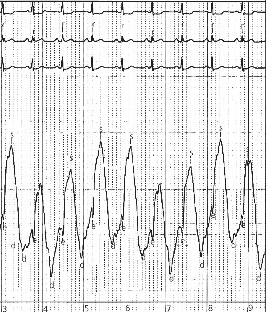 ECG of RV pressure tracing in a patient with RV ischemia, displaying RV waveform with sluggish upstroke, depressed broadened systolic peak, delayed relaxation phase, and diminished RV stroke work.