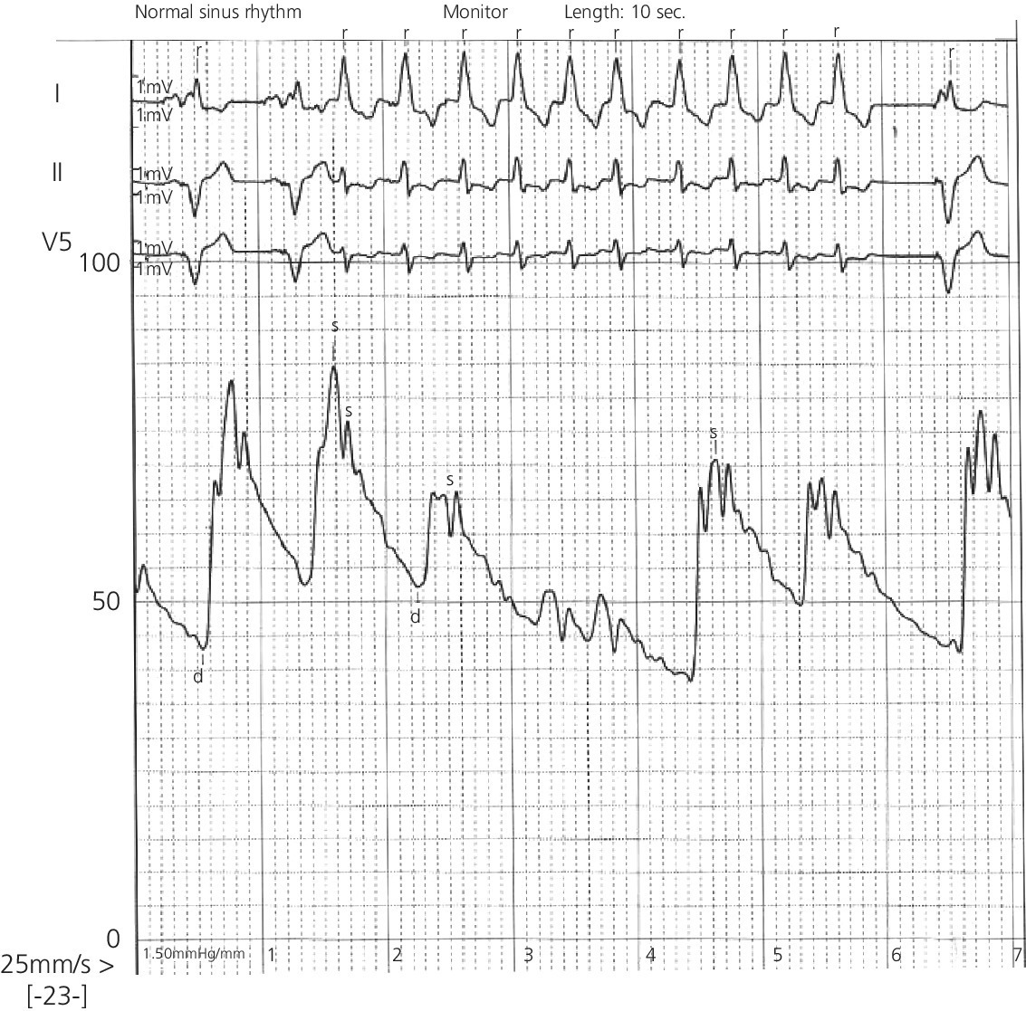 ECG displaying aortic pressure in an elderly woman with permanent pacemaker and transient episode of ventricular tachycardia.