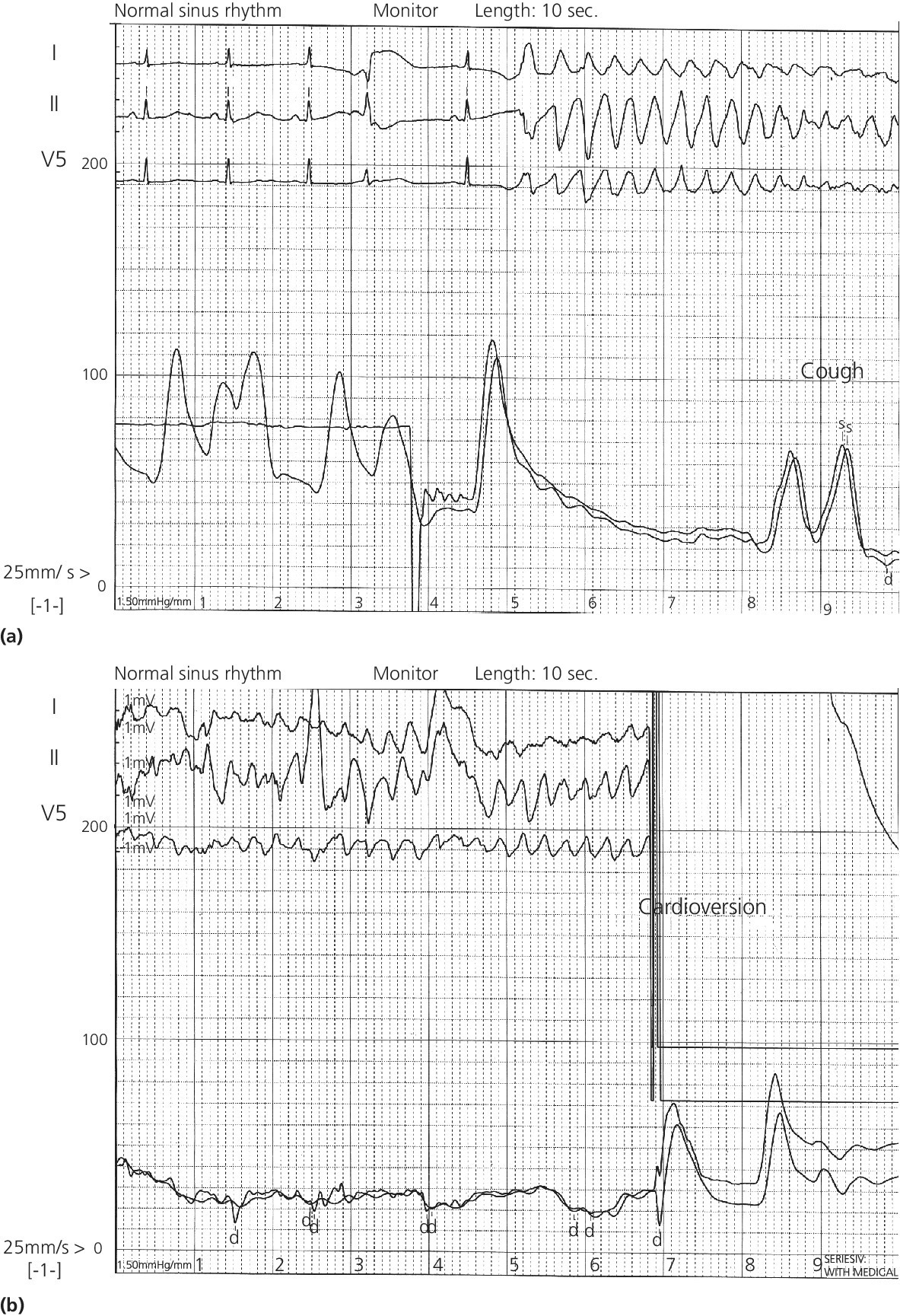 ECGs of patient with ventricular tachycardia, illustrating aortic pressure increase with cough (top) and return of pulsatile blood pressure after electrical cardioversion (bottom).