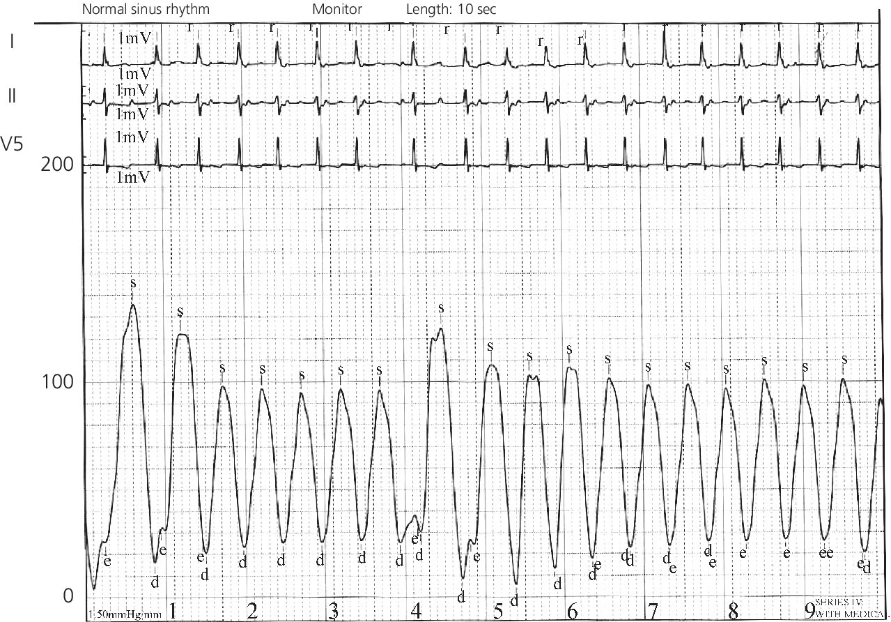 ECG displaying left ventricular pressure during an episode of junctional tachycardia.