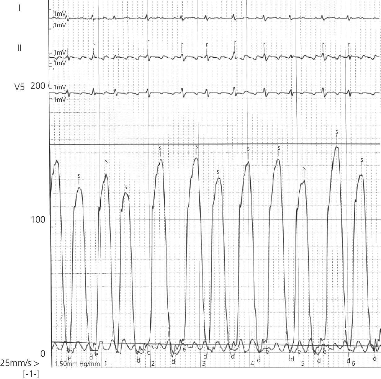 ECG of left ventricular and right atrial pressure, with regular atrial activity reflected as flutter waves.