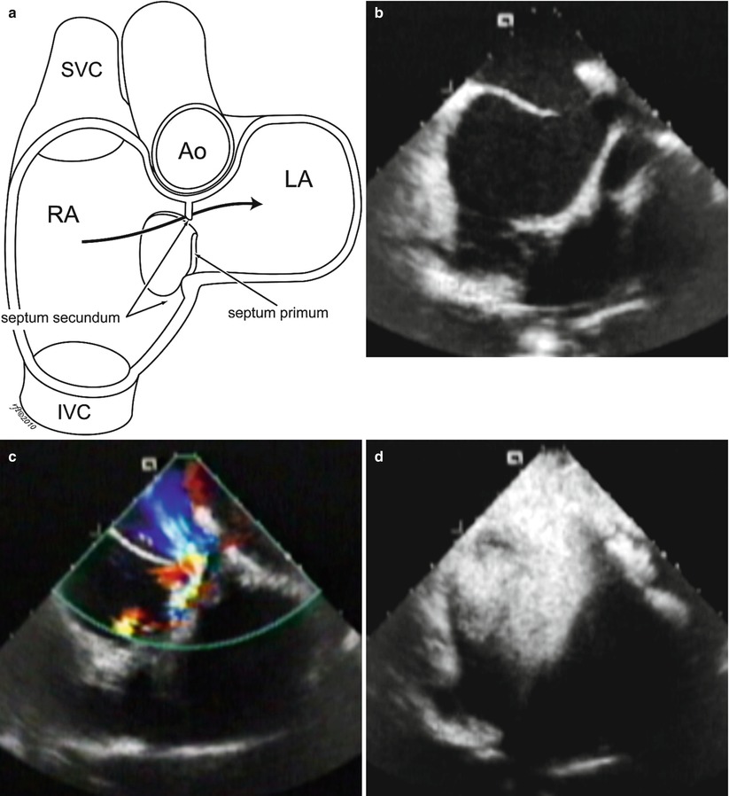 Anatomical Variations Of Patent Foramen Ovale | Thoracic Key