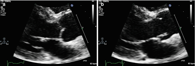 Echocardiographic Evaluation Of Aortic Valve Stenosis | Thoracic Key