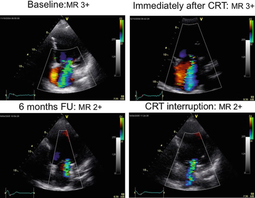 Role Of Cardiac Resynchronization Therapy | Thoracic Key