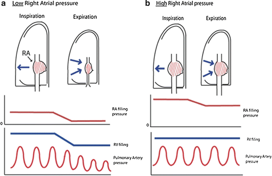 The Right Ventricle In Chronic Lung Diseases | Thoracic Key