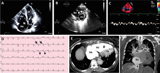 Acute Right Ventricular Failure | Thoracic Key