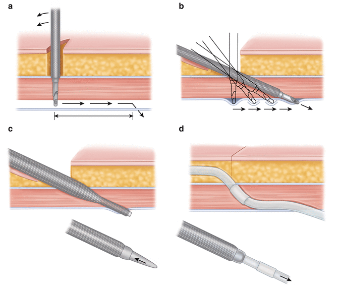 Advanced Laparoscopic Insertion Of Peritoneal Dialysis Catheters ...