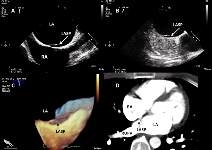 The Left Atrial Septal Pouch As A Risk Factor For Stroke: A Systematic ...